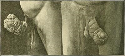 Top Plantar Wart Removal Cost Fast