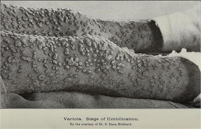 Best Wart Removal Homeopathic Remedies Now