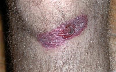 Best Skin Tag Removal Cpt Fast