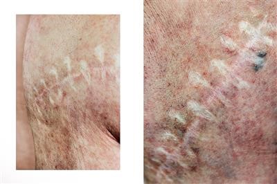 Best Mole Removal Doctor Or Dermatologist Fast