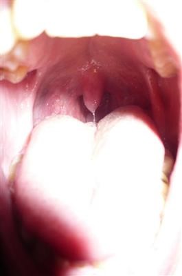 Choice Plantar Wart Removal Surgery Near Me Now