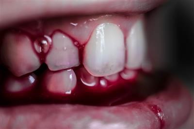 Choice Wart Remover Oclusal Hc Now