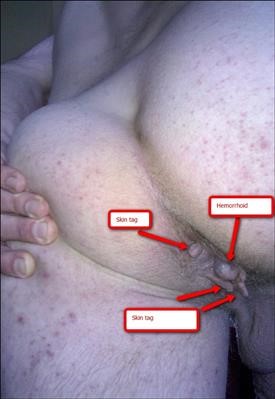 Best Compound W Wart Remover Directions Near You
