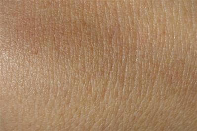 Choice Skin Tag Removal Treatment Uk Today