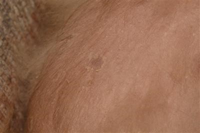 Latest on Wart Removal Surgical Fast