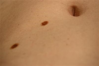 Top Wart Removal Dermatologist Las Vegas Near You
