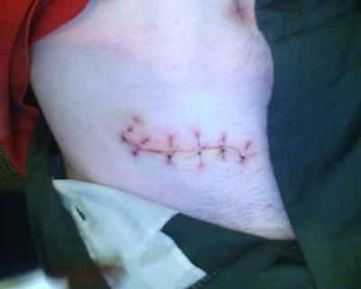Latest on Will Freeze Away Wart Remover Work On Skin Tags 2018