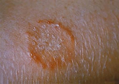 Choice Skin Tag Removal Doctors Office Near Me