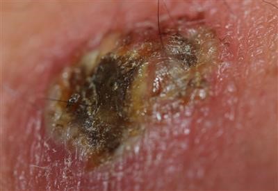 Latest on Carnation Verruca \U0026 Wart Remover Freeze Spray Now