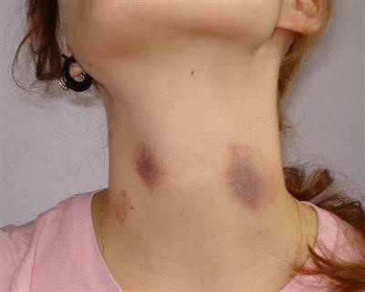 Latest on Will Liquid Wart Remover Work On Skin Tags 2018