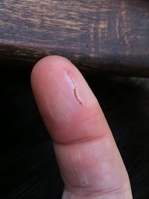 Top Wart Removal Surgery Near Me Near You