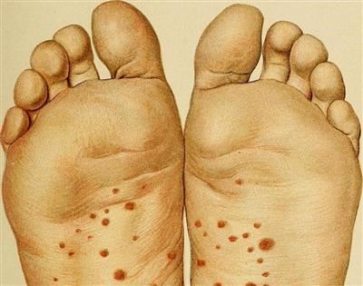 Latest on Laser Treatment Wart Removal Cost Bear by