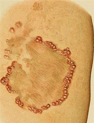 Choice Wart Removal Cost In Pune