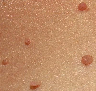 Top Treating Flat Warts Otc