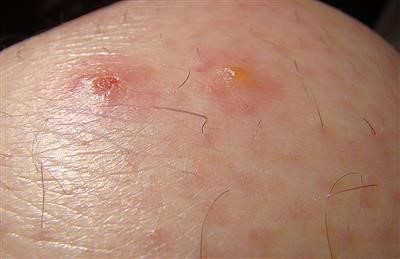 Choice Mole Removal Infection Photos Near You