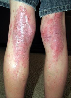 No 1 Mole Removal Cost Without Insurance Fast