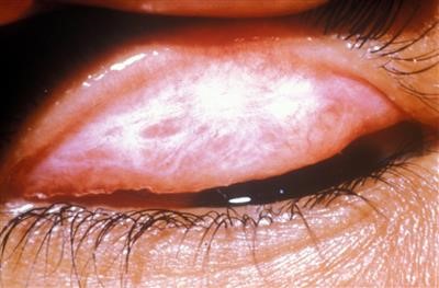 Top Skin Tag Removal Pen Video