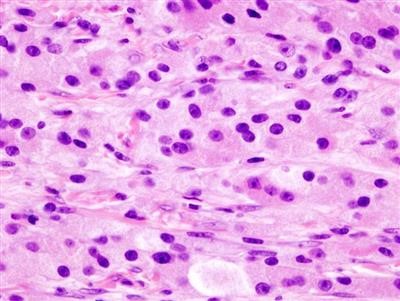 Latest on Can You Use Normal Wart Remover Genital Warts Near You